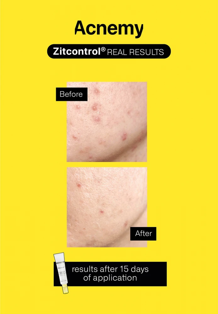 Acnemy - Крем для проблемної шкіри Zitcontrol - Зображення 2